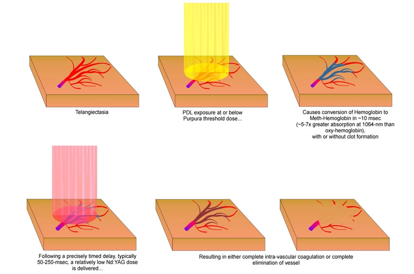 Schéma du principe de fonctionnement du laser vasculaire pour le traitement de la couperose Schéma du principe de fonctionnement du laser vasculaire pour le traitement de la couperose