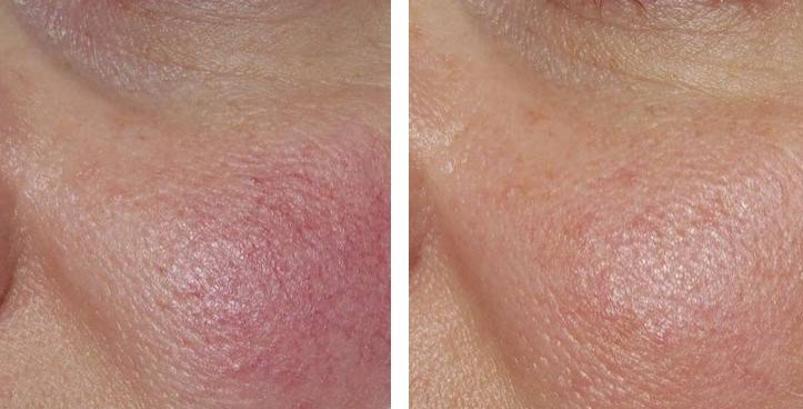 Treatment of redness and rosacea laser Metz