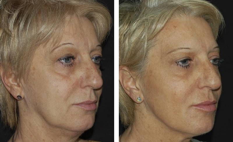 Botox Botox