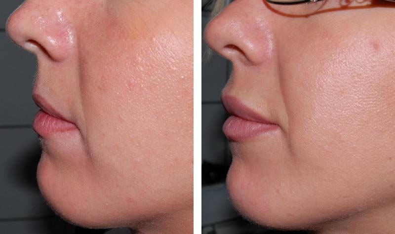 Traitement des lèvres par injections : photos avant / après