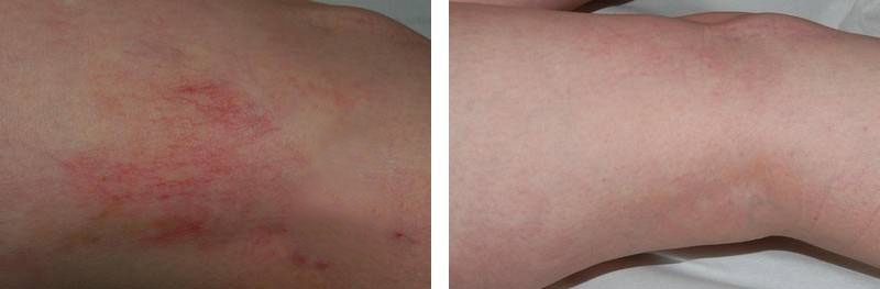 varicosités des jambes : photo avant / après de traitement au laser