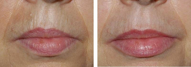 Réjunénation des lèvres par injection photo avant / après